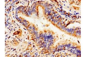 Immunohistochemistry of paraffin-embedded human lung cancer using ABIN7144912 at dilution of 1:100