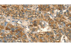 Immunohistochemistry of paraffin-embedded Human liver cancer using HSD17B8 Polyclonal Antibody at dilution of 1:55 (HSD17B8 抗体)