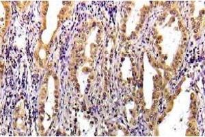 Immunohistochemistry (IHC) analyzes of STAT3 pAb in paraffin-embedded human lung carcinoma tissue. (STAT3 抗体)