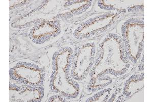 Immunohistochemical staining of paraffin-embedded Endometrial CA using YIPF4 antibody at a dilution of 1:500 (YIPF4 抗体)