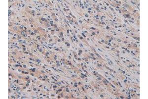 IHC-P analysis of Human Prostate Gland Cancer Tissue, with DAB staining. (CD147 抗体  (AA 79-280))