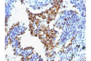 Formalin-fixed, paraffin-embedded human Lung Adenocarcinoma stained with Napsin-A Monoclonal Antibody (NAPSA/1238 + NAPSA/1239). (NAPSA 抗体  (AA 189-299))