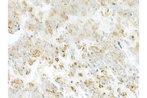 ABIN6264754 and ABIN6273309 at 1/100 staining human melanoma by IHC-P. (RIC8B 抗体  (C-Term))