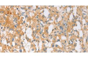 Immunohistochemistry of paraffin-embedded Human thyroid cancer using EPS15L1 Polyclonal Antibody at dilution of 1:30 (EPS15L1 抗体)