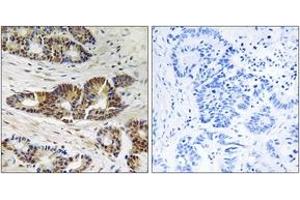Immunohistochemistry analysis of paraffin-embedded human colon carcinoma tissue, using GRK2 (Ab-685) Antibody.