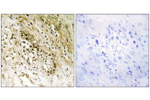Immunohistochemistry analysis of paraffin-embedded human prostate carcinoma tissue, using PDZD2 antibody. (PDZD2 抗体  (N-Term))