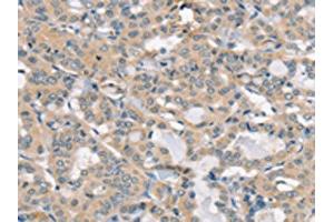 The image on the left is immunohistochemistry of paraffin-embedded Human thyroid cancer tissue using ABIN7192520(SLC6A8 Antibody) at dilution 1/30, on the right is treated with synthetic peptide. (SLC6A8 抗体)