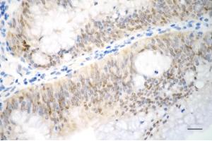 Immunohistochemistry was performed on paraffin-embedded human sigmoid colon carcinoma using p21 antibody (ABIN7798222), 1:200). (Recombinant p21 抗体)