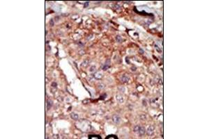 Formalin-fixed and paraffin-embedded human cancer tissue reacted with the primary antibody, which was peroxidase-conjugated to the secondary antibody, followed by AEC staining. (BRD2 抗体  (AA 170-200))
