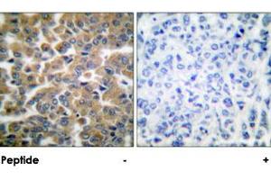 Immunohistochemical analysis of paraffin-embedded human breast carcinoma tissue using NR3C1 polyclonal antibody . (Glucocorticoid Receptor 抗体)