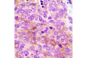 Immunohistochemical analysis of AMPK gamma 2 staining in human breast cancer formalin fixed paraffin embedded tissue section. (PRKAG2 抗体  (N-Term))