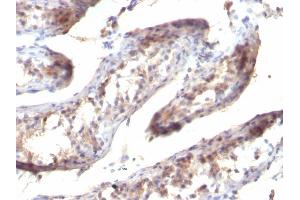 Formalin-fixed, paraffin-embedded human Testicular Carcinoma stained with TGF alpha Mouse Monoclonal Antibody (SPM357) (TGFA 抗体  (C-Term))