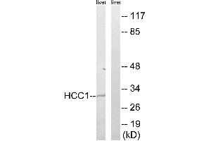 Immunohistochemistry analysis of paraffin-embedded human breast carcinoma tissue, using HCC1 antibody. (RBM39 抗体  (Internal Region))