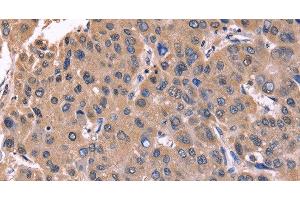Immunohistochemistry of paraffin-embedded Human liver cancer tissue using CSNK1D Polyclonal Antibody at dilution 1:50 (Casein Kinase 1 delta 抗体)