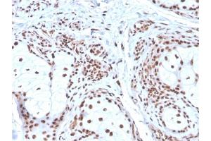 Formalin-fixed, paraffin-embedded human Basal Cell Carcinoma stained with Nucleophosmin Mouse Monoclonal Antibody (NPM1/3286). (NPM1 抗体  (AA 185-287))