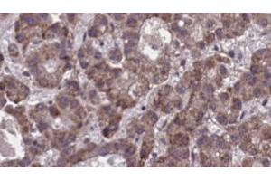 ABIN6273900 at 1/100 staining Human liver cancer tissue by IHC-P. (Purinergic Receptor P2Y, G-Protein Coupled, 13 (P2RY13) (C-Term) 抗体)