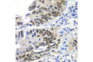 Immunohistochemistry of paraffin-embedded human colon carcinoma using DACH1 antibody at dilution of 1:100 (x40 lens). (DACH1 抗体)