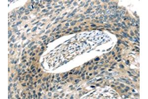 The image on the left is immunohistochemistry of paraffin-embedded Human esophagus cancer tissue using ABIN7193008(VAMP2 Antibody) at dilution 1/20, on the right is treated with synthetic peptide. (VAMP2 抗体)