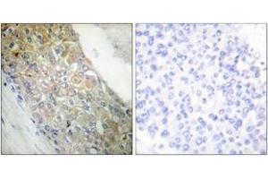 Immunohistochemistry analysis of paraffin-embedded human breast carcinoma tissue, using IR (Ab-1355) Antibody. (IR (AA 1326-1375) 抗体)