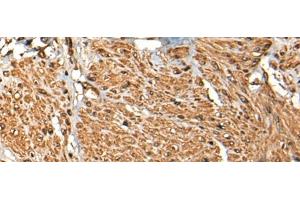 Immunohistochemistry of paraffin-embedded Human prost ate cancer tissue using MICU1 Polyclonal Antibody at dilution of 1:35(x200) (MICU1 抗体)