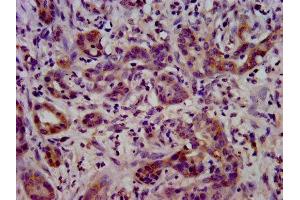 IHC image of ABIN7158426 diluted at 1:400 and staining in paraffin-embedded human pancreatic cancer performed on a Leica BondTM system. (LSR 抗体  (AA 112-233))