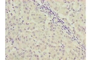 Immunohistochemistry of paraffin-embedded human liver cancer using ABIN7166922 at dilution of 1:100 (C9orf64 抗体  (AA 182-341))