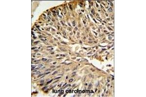 DHFR Antibody (C-term) (ABIN391566 and ABIN2841504) IHC analysis in formalin fixed and paraffin embedded human lung carcinoma followed by peroxidase conjugation of the secondary antibody and DAB staining. (Dihydrofolate Reductase 抗体  (C-Term))