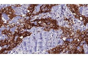 ABIN6277723 at 1/100 staining Human Head and neck cancer tissue by IHC-P. (SLC2A2 抗体  (N-Term))