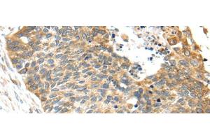 Immunohistochemistry of paraffin-embedded Human esophagus cancer tissue using TNFAIP8 Polyclonal Antibody at dilution 1:35 (TNFAIP8 抗体)