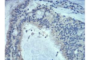 Immunohistochemical analysis of paraffin-embedded colon cancer tissues using Rab5a mouse mAb with DAB staining. (RAB5 抗体  (AA 1-215))