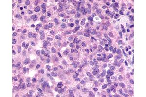 Anti-GPR98 / VLGR1 antibody IHC of human Ovary, Carcinoma. (ADGRV1 / GPR98 抗体  (N-Term))