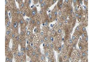 ABIN6266590 at 1/100 staining human liver carcinoma tissue sections by IHC-P. (MMP11 抗体  (N-Term))