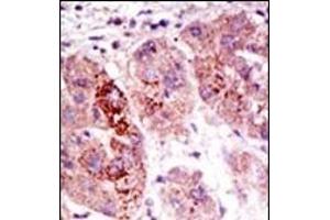 Formalin-fixed and paraffin-embedded human cancer tissue reacted with the primary antibody, which was peroxidase-conjugated to the secondary antibody, followed by AEC staining. (USP7 抗体  (C-Term))