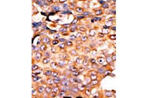 Formalin-fixed and paraffin-embedded human cancer tissue reacted with the primary antibody, which was peroxidase-conjugated to the secondary antibody, followed by AEC staining. (PANK3 抗体  (AA 150-181))