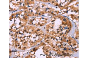 Immunohistochemistry of Human thyroid cancer using HIST1H1C Polyclonal Antibody at dilution of 1:70 (HIST1H1C 抗体)