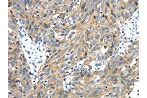 The image on the left is immunohistochemistry of paraffin-embedded Human breast cancer tissue using ABIN7131402(TMPRSS13 Antibody) at dilution 1/30, on the right is treated with fusion protein. (TMPRSS13 抗体)