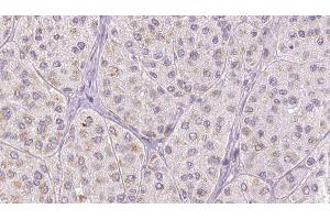 ABIN6278027 at 1/100 staining Human melanoma tissue by IHC-P. (FGA 抗体  (C-Term))