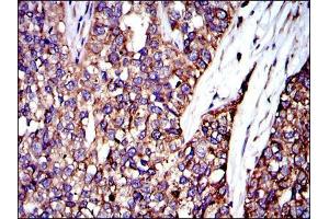 Immunohistochemical analysis of paraffin-embedded bladder cancer tissues using CRK mouse mAb with DAB staining.