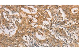 Immunohistochemistry of paraffin-embedded Human gastric cancer tissue using ARSG Polyclonal Antibody at dilution 1:30