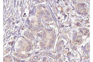 ABIN6275873 at 1/100 staining Human breast cancer tissue by IHC-P.