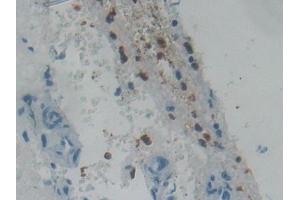 Detection of RNASE3 in Human Glioma Tissue using Polyclonal Antibody to Ribonuclease A3 (RNASE3) (RNASE3 抗体  (AA 30-154))