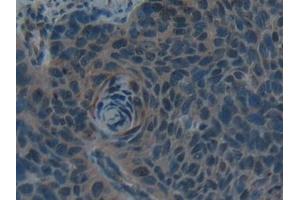 Detection of Hepc in Human Esophagus cancer Tissue using Polyclonal Antibody to Hepcidin (Hepc) (Hepcidin 抗体  (AA 25-84))
