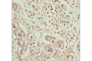 Immunohistochemistry of paraffin-embedded human pancreatic cancer using ABIN7159626 at dilution of 1:100 (MCCC2 抗体  (AA 284-563))