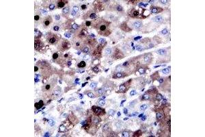 Immunohistochemical analysis of XPC staining in human liver cancer formalin fixed paraffin embedded tissue section. (XPC 抗体)