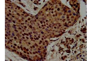IHC image of ABIN7168396 diluted at 1:500 and staining in paraffin-embedded human pancreatic cancer performed on a Leica BondTM system. (Raly 抗体  (AA 254-306))
