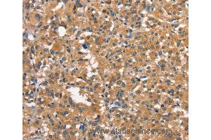 Immunohistochemistry of Human thyroid cancer using DNM2 Polyclonal Antibody at dilution of 1:40 (DNM2 抗体)