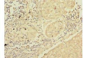 Immunohistochemistry of paraffin-embedded human lung cancer using ABIN7166622 at dilution of 1:100 (Surfactant Protein C 抗体  (AA 24-58))