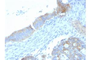 Formalin-fixed, paraffin-embedded human Colon Carcinoma stained with Heparan Sulfate Monoclonal Antibody (SPM255).