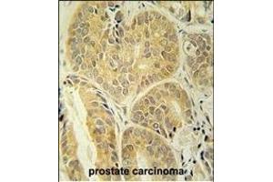 EN Antibody (C-term) (ABIN652020 and ABIN2840500) immunohistochemistry analysis in formalin fixed and paraffin embedded human prostate carcinoma followed by peroxidase conjugation of the secondary antibody and DAB staining. (Enamelin 抗体  (C-Term))