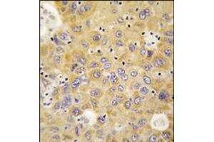 Formalin-fixed and paraffin-embedded human hepatocarcinoma tissue reacted with AARS antibody (N-term), which was peroxidase-conjugated to the secondary antibody, followed by DAB staining. (AARS 抗体  (N-Term))